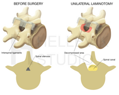 Operative treatment spinal stenosis